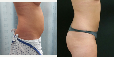 Liposuction before and after photo