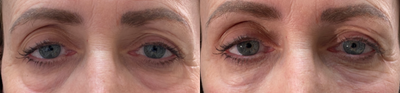 Restylane before and after photo
