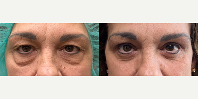 Chemical Peel before and after photo