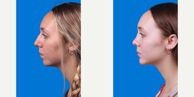 Chin Implant before and after photo