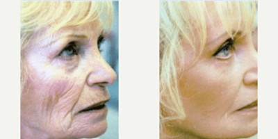 CO2 Laser before and after photo