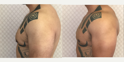 Gynecomastia Surgery before and after photo