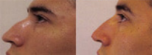 Nonsurgical Nose Job before and after photo