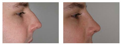 Rhinoplasty before and after photo