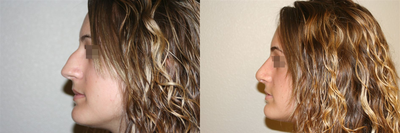 Rhinoplasty before and after photo