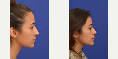 Rhinoplasty before and after photo