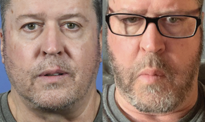 Beard Transplant before and after photo
