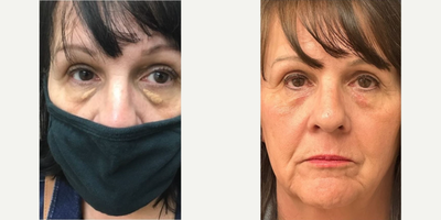 CO2 Laser before and after photo
