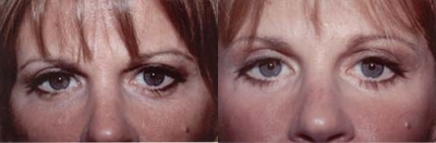 Eyelid Surgery before and after photo