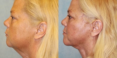 Facelift before and after photo