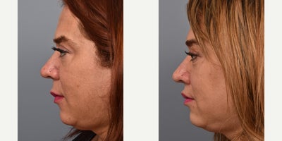 Lip Lift before and after photo
