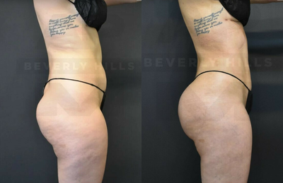Lipo 360 BBL before and after photo