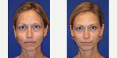 Liquid Facelift before and after photo