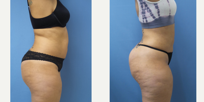 Smart Lipo before and after photo