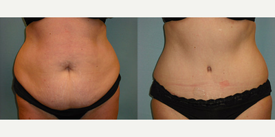 Tummy Tuck before and after photo