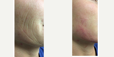 Belotero before and after photo