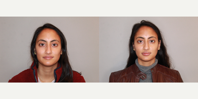 Cheek Fillers before and after photo