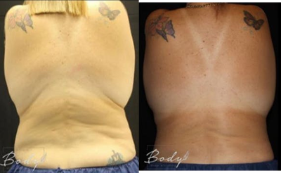 CoolSculpting before and after photo