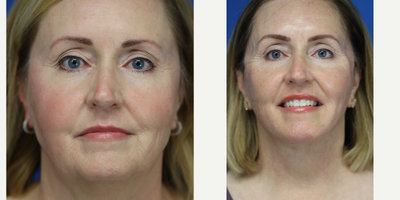Facelift before and after photo