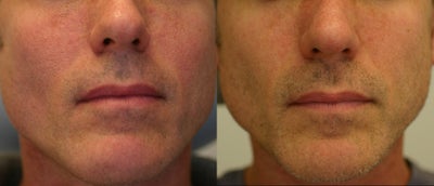 Laser Resurfacing before and after photo