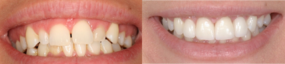 Lumineers before and after photo