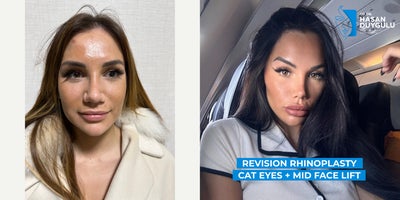 Revision Rhinoplasty before and after photo