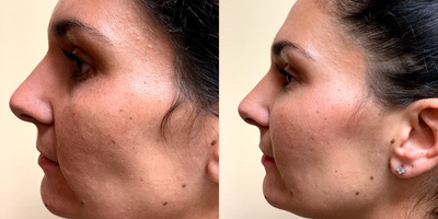 Dermal Fillers before and after photo