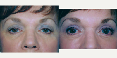 Eyelid Surgery before and after photo