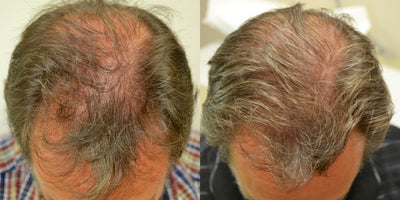 Hair Loss Treatment before and after photo