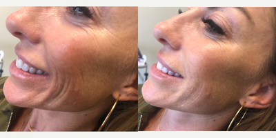 Juvederm before and after photo
