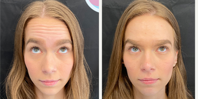 Botox before and after photo
