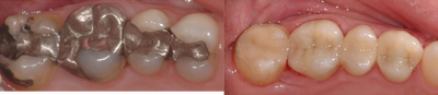 Dental Crown before and after photo