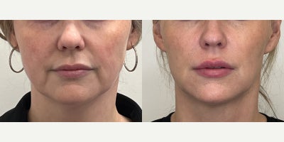 Dermal Fillers before and after photo