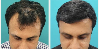 Hair Transplant before and after photo