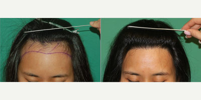 Hair Transplant before and after photo