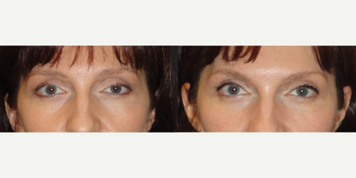 Botox before and after photo