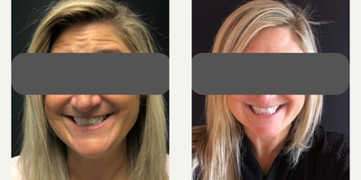Botox before and after photo