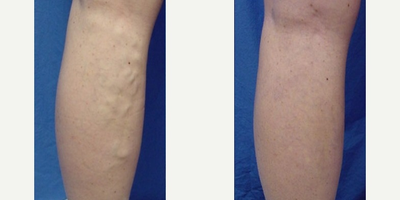 Sclerotherapy before and after photo