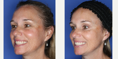 Botox before and after photo