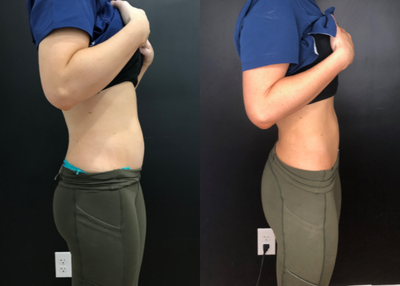 Emsculpt before and after photo