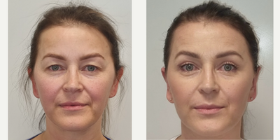 Eyelid Surgery before and after photo