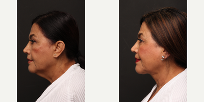 FaceTite before and after photo