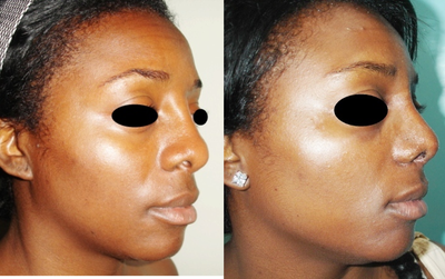 African American Rhinoplasty before and after photo