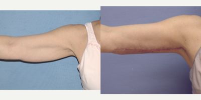 Arm Lift before and after photo