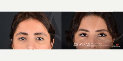 Brow Lift before and after photo