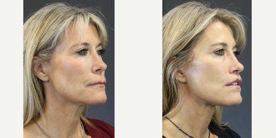 Deep Plane Facelift before and after photo