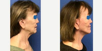 Facelift before and after photo
