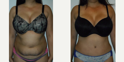 Tummy Tuck before and after photo