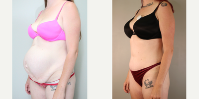 Tummy Tuck before and after photo