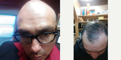 Hair Transplant before and after photo